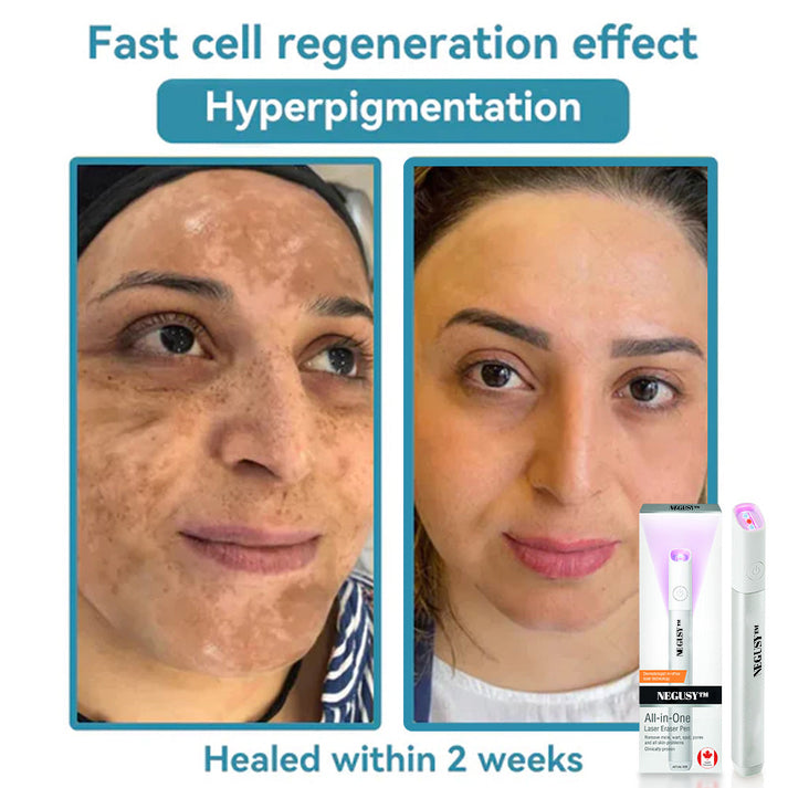 All-in-One CO₂ Laser Eraser Pen | Removes Moles, Warts, Skin Flaws & Pigmentation