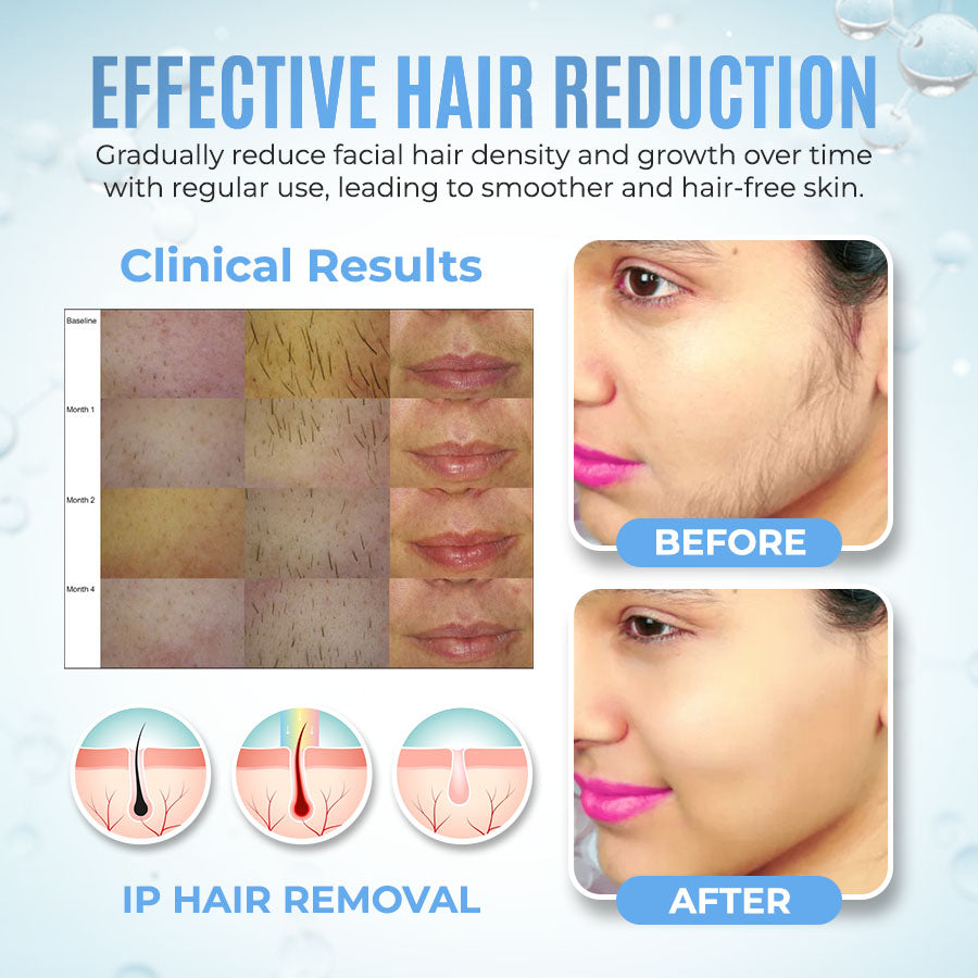 PCOS Facial Hair Natural Treatment At Home 💡
