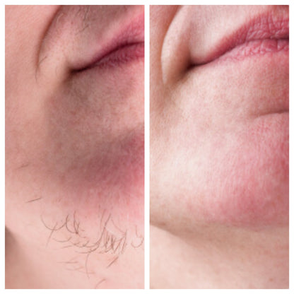 PCOS Facial Hair Natural Treatment At Home 💡