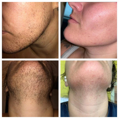 PCOS Facial Hair Natural Treatment At Home 💡