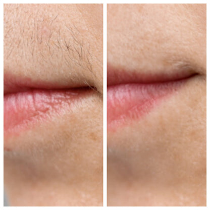 PCOS Facial Hair Natural Treatment At Home 💡