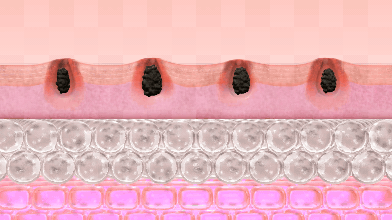 PCOS Facial Hair Natural Treatment At Home 💡