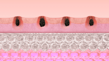 PCOS Facial Hair Natural Treatment At Home 💡